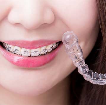 Braces Vs. Invisalign